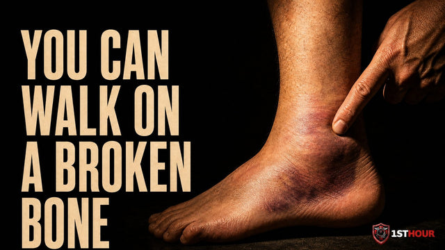 How to Tell If a Bone Is Broken Before You Reach an ER