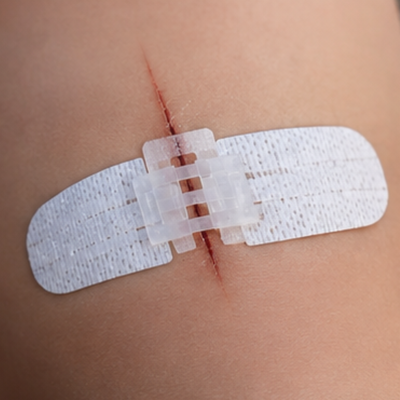 Close-up of a wound closure strip holding a cut closed